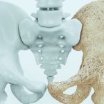 علل و عوامل خطر بروز پوکی استخوان
