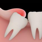 هر چیزی که باید درباره دندان عقل بدانید